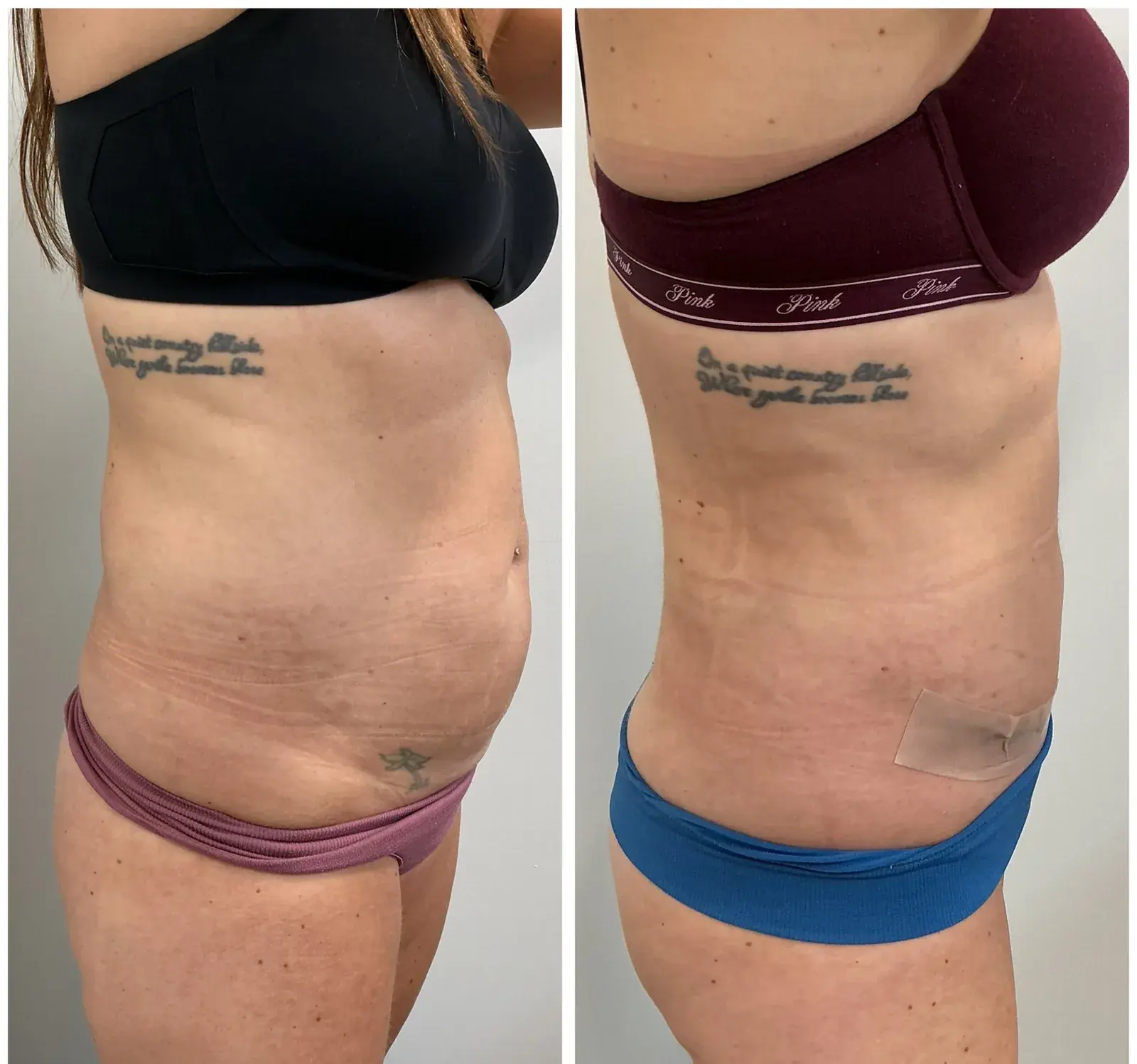 Abdomen, side view, before and after at Barrie Plastic Surgery