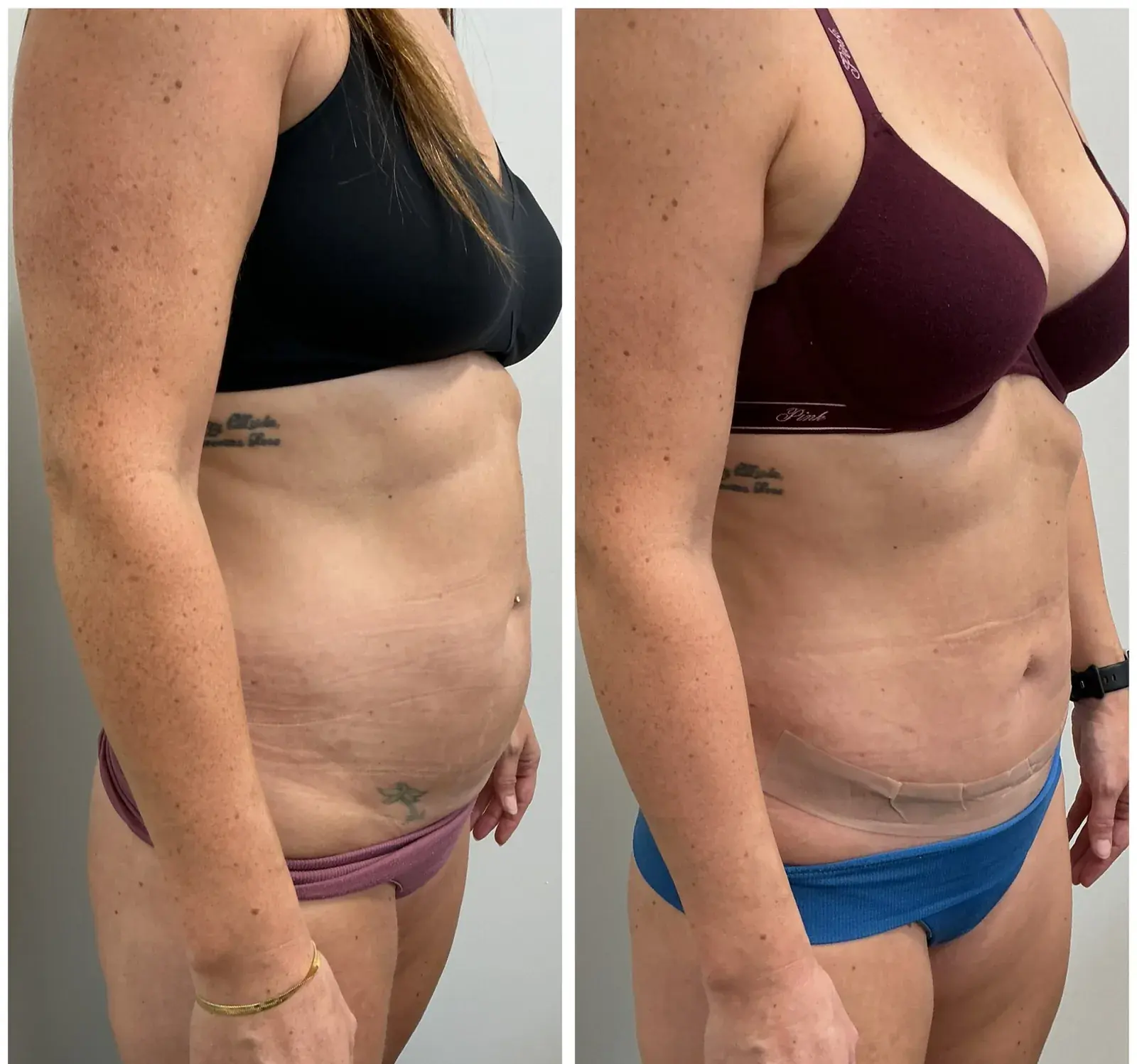 Abdomen, oblique view, before and after at Barrie Plastic Surgery