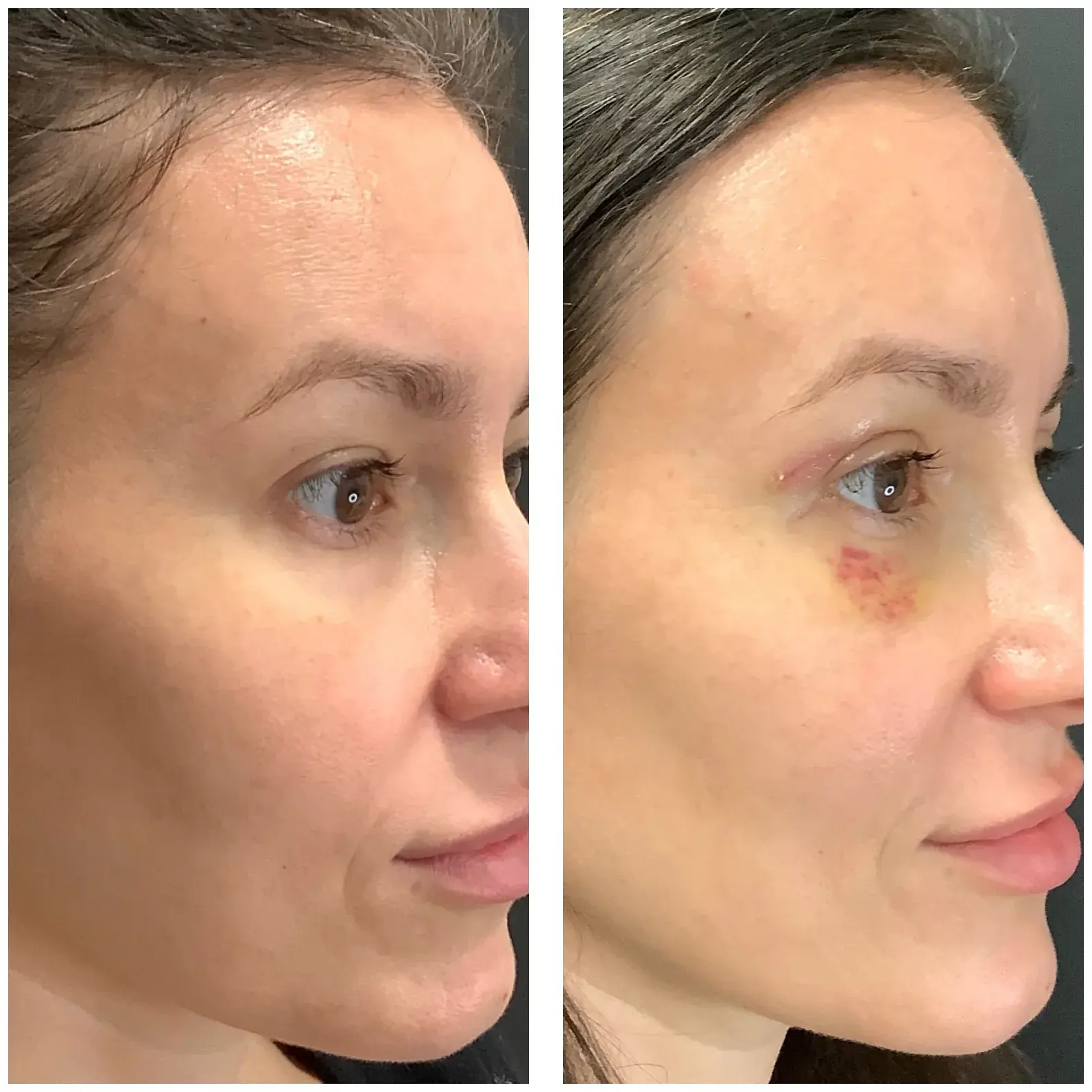Upper eyelids, side view, before and after at Barrie Plastic Surgery