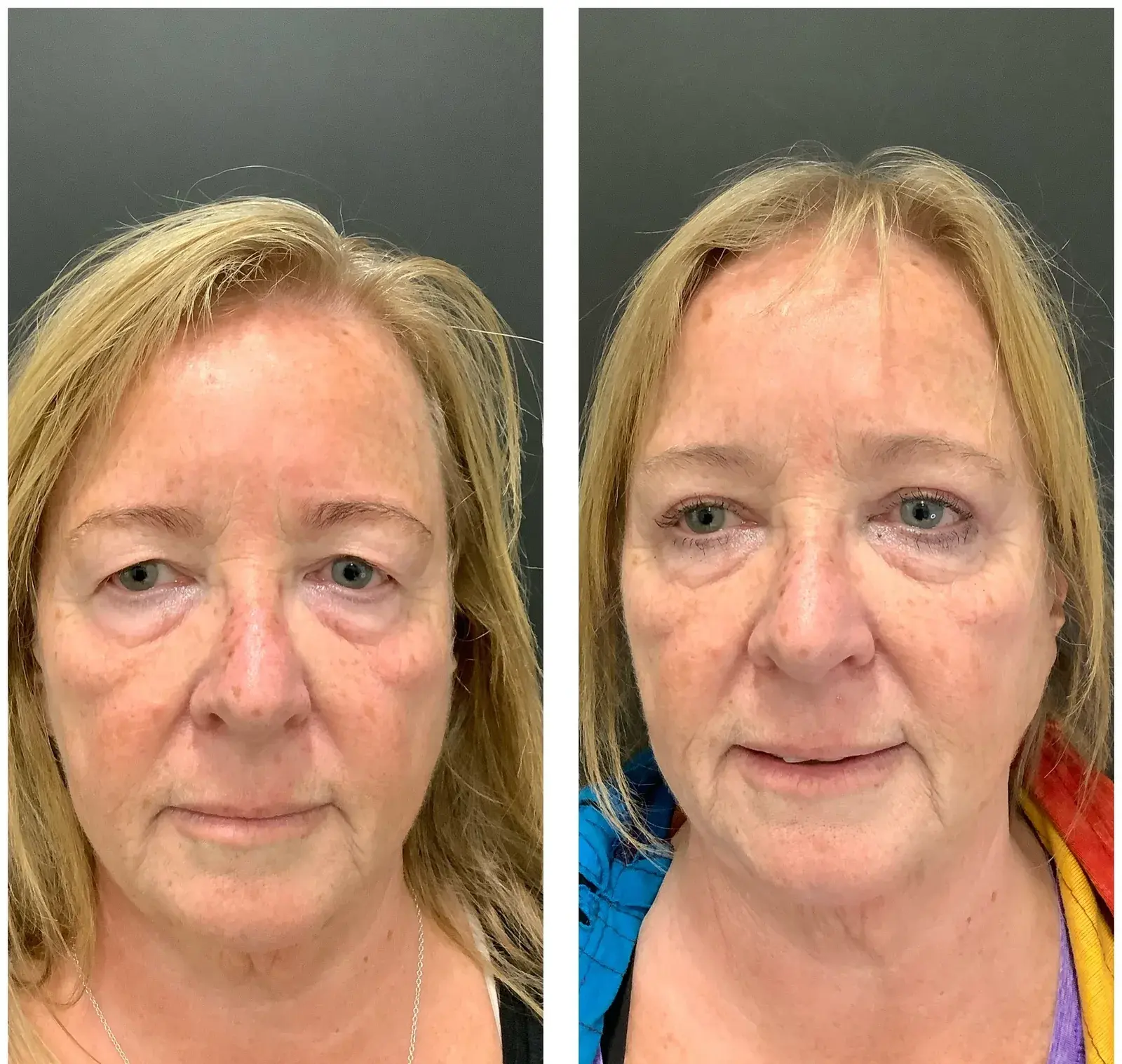 Upper eyelids, front view, before and after at Barrie Plastic Surgery