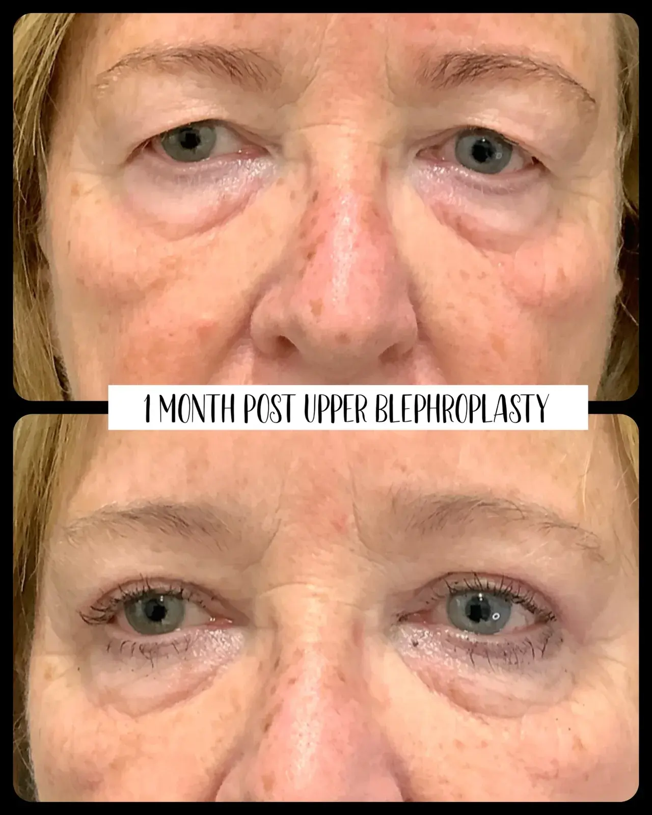 Upper eyelids, front view, before and after at Barrie Plastic Surgery