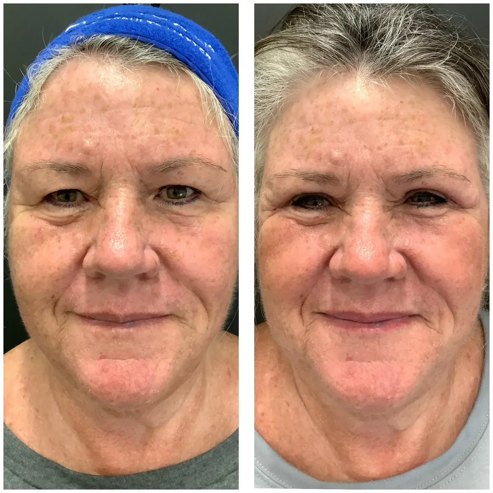 Upper eyelids, front view, before and after at Barrie Plastic Surgery