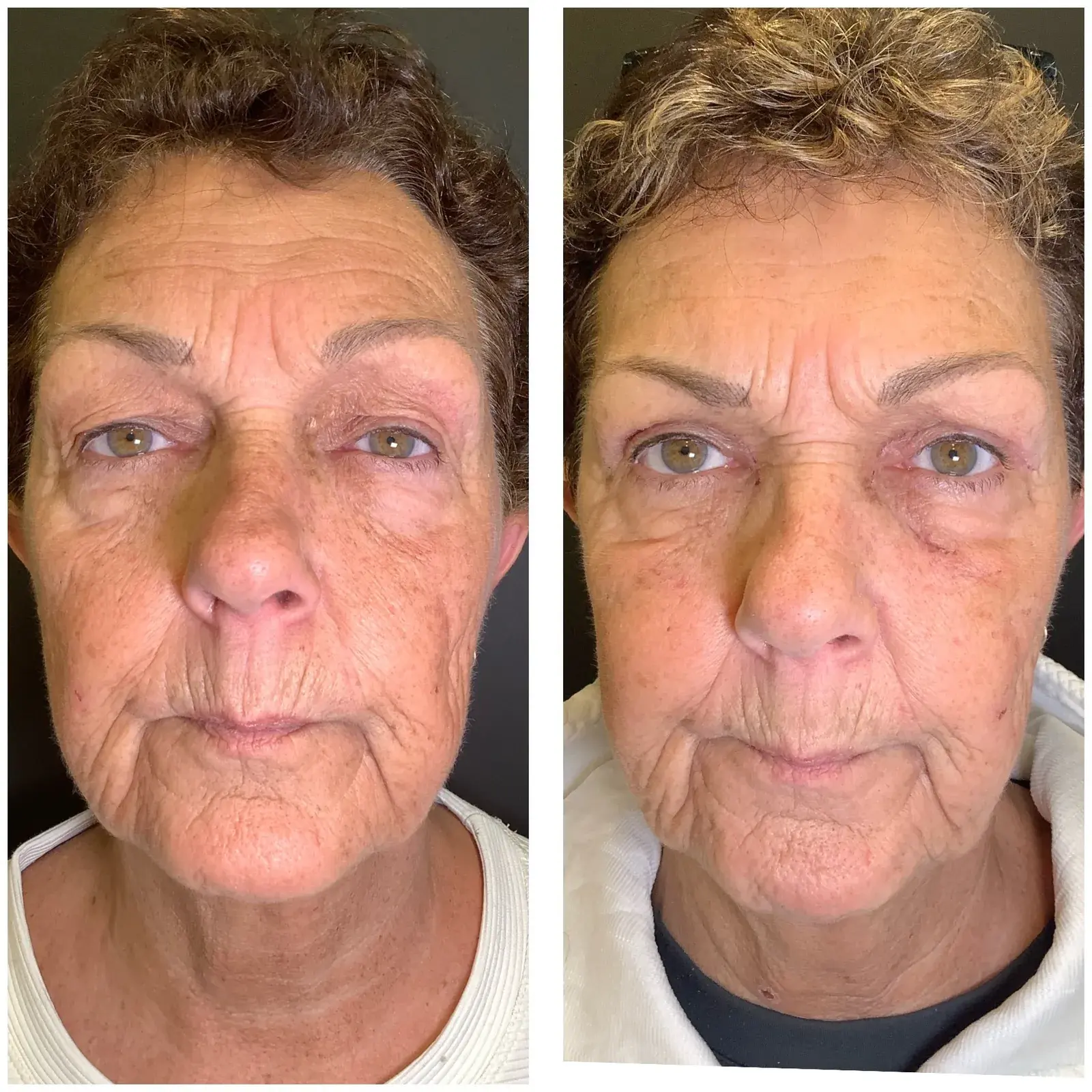 Upper eyelids, front view, before and after at Barrie Plastic Surgery