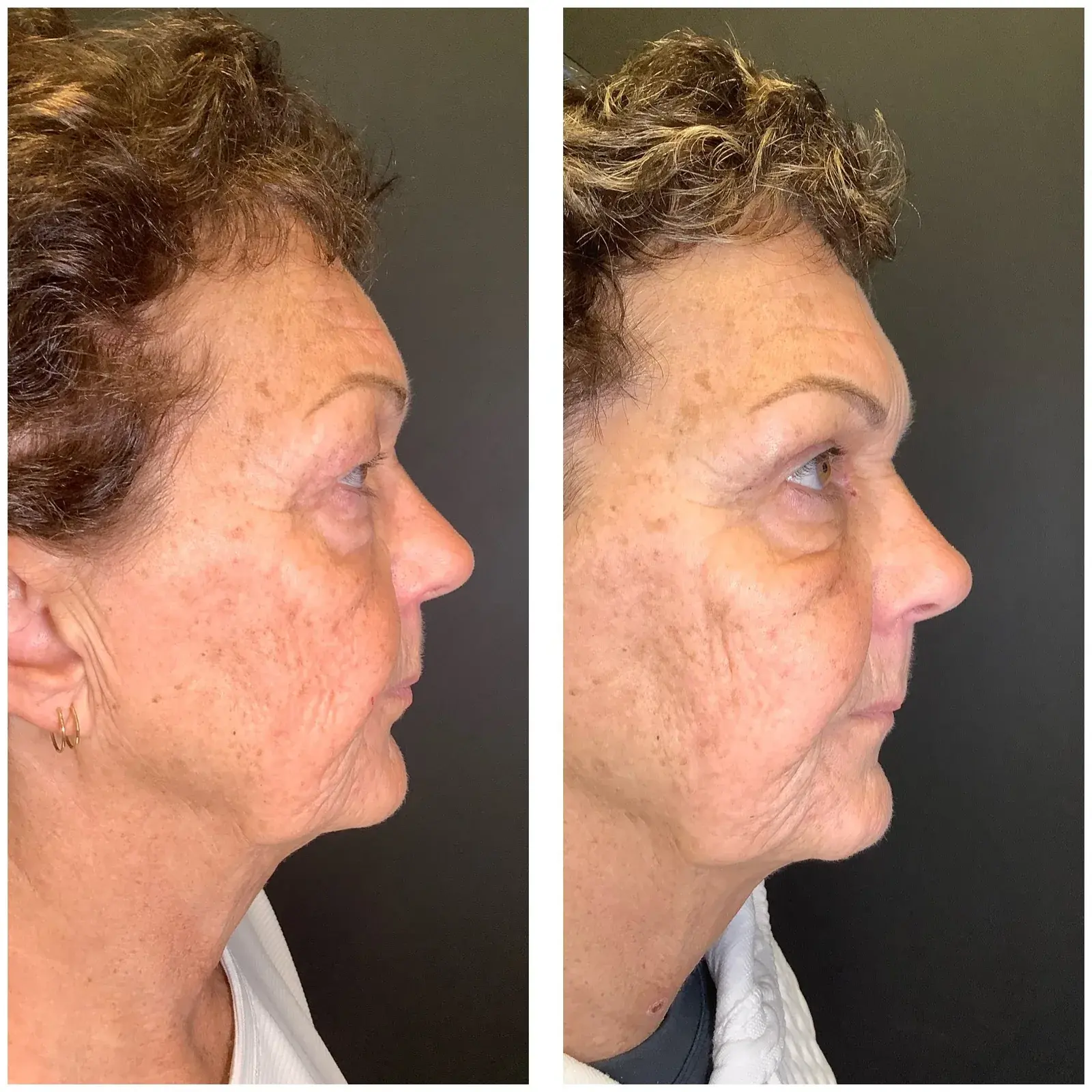Upper eyelids, side view, before and after at Barrie Plastic Surgery
