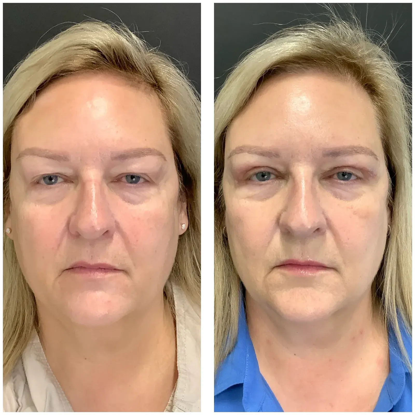 Upper eyelids, front view, before and after at Barrie Plastic Surgery