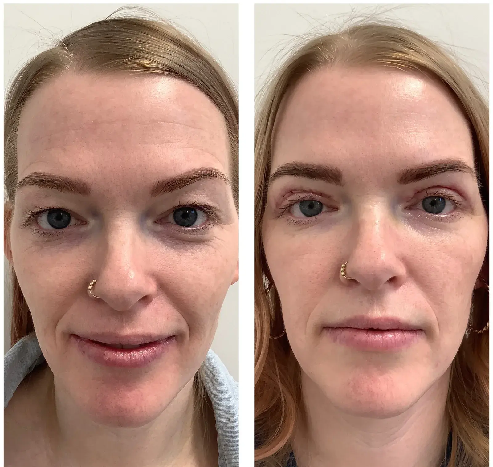 Upper eyelids, front view, before and after at Barrie Plastic Surgery