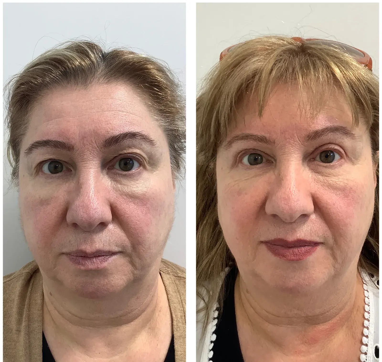 Upper eyelids, front view, before and after at Barrie Plastic Surgery