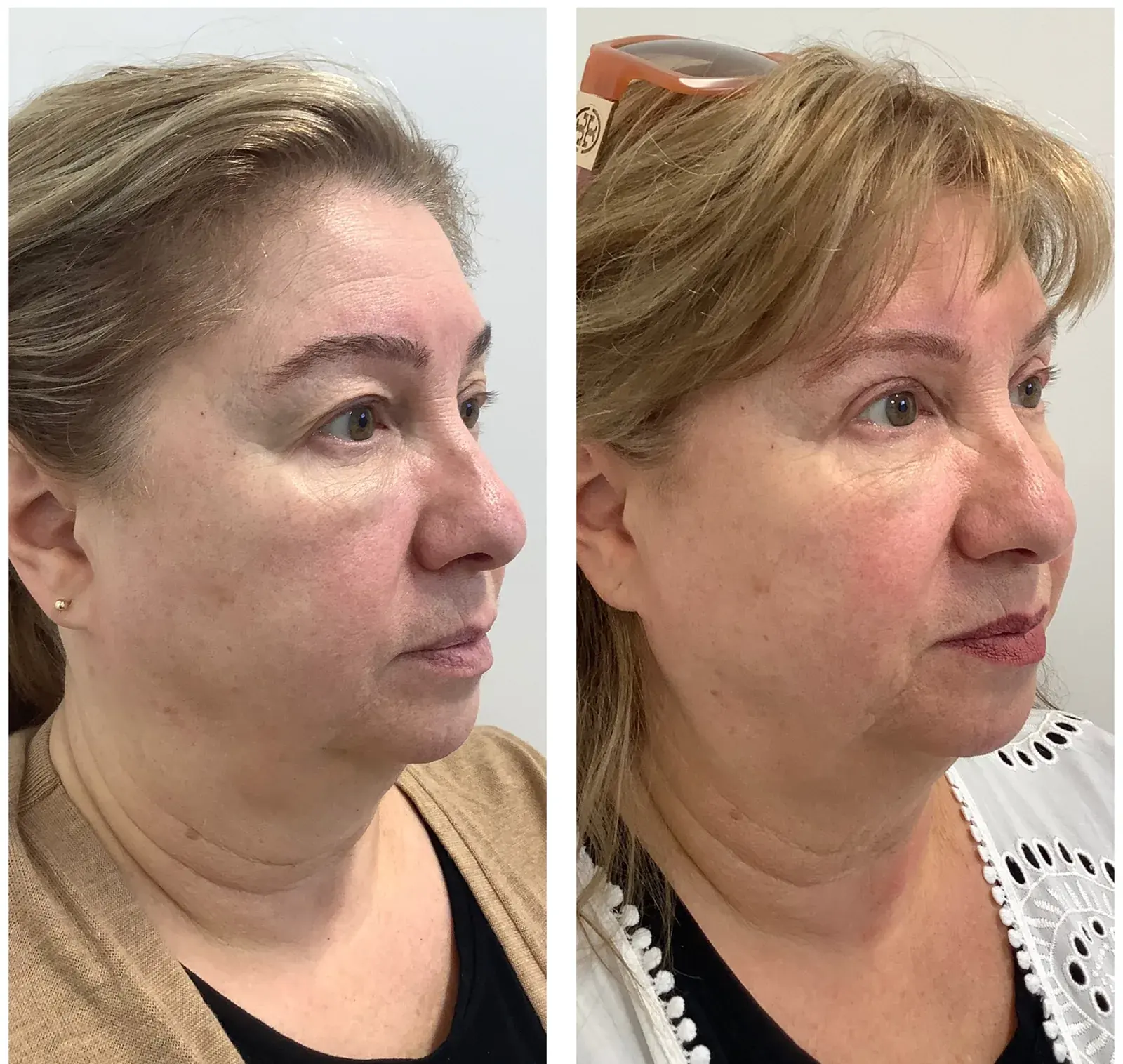 Upper eyelids, oblique view, before and after at Barrie Plastic Surgery