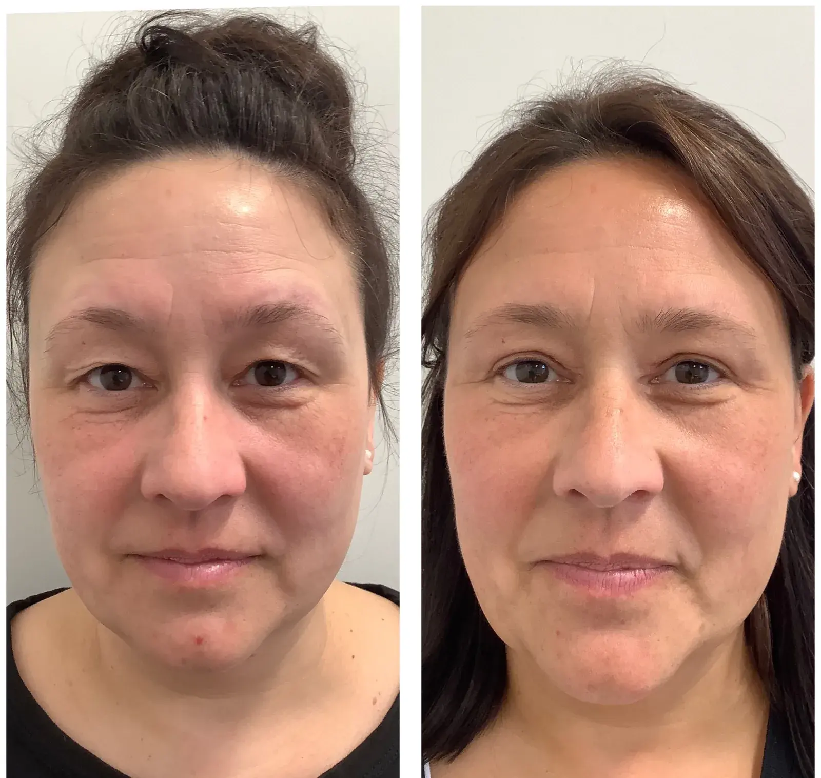 Upper eyelids, front view, before and after at Barrie Plastic Surgery