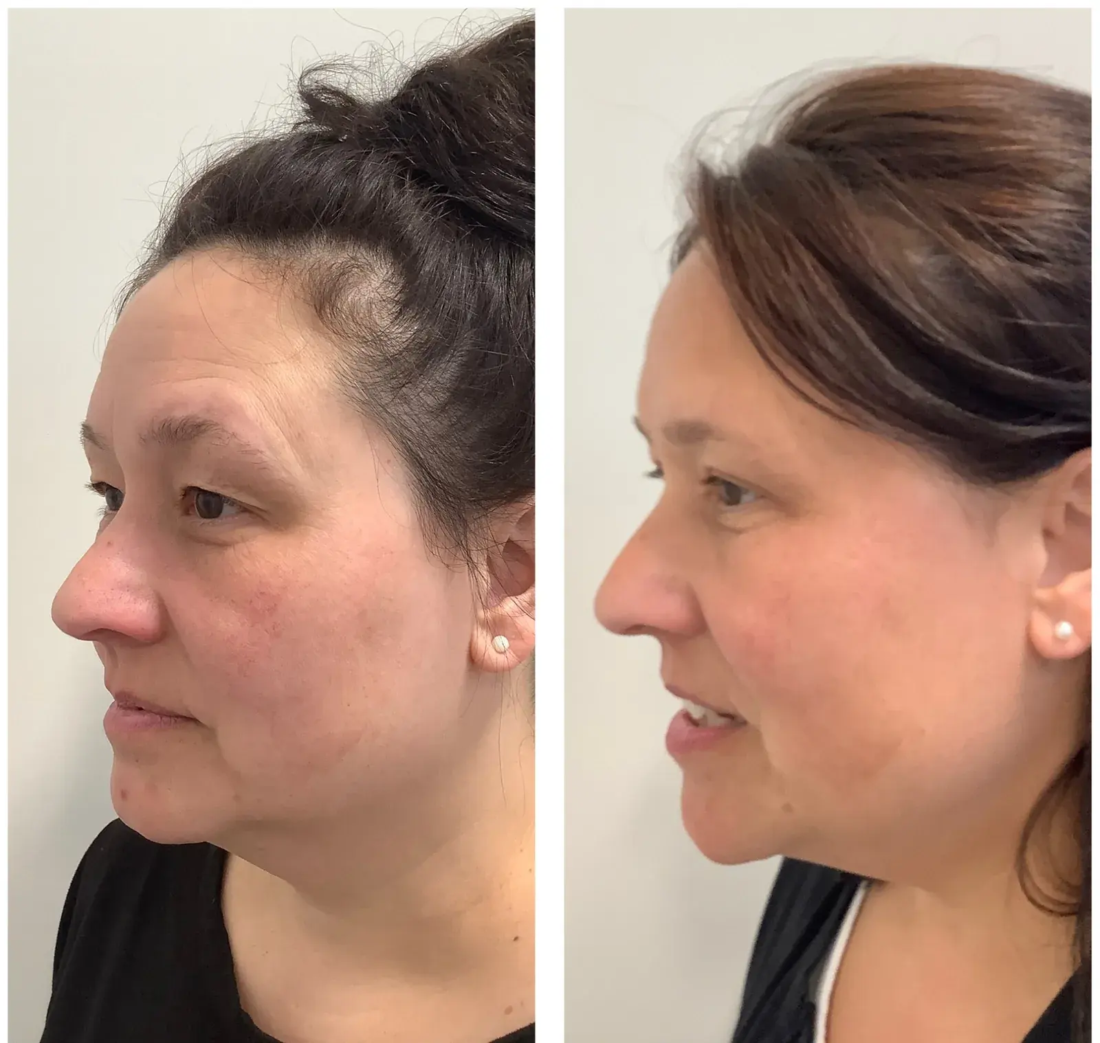 Upper eyelids, side view, before and after at Barrie Plastic Surgery