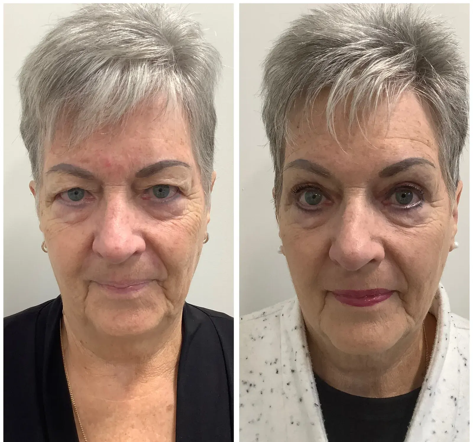 Upper eyelids, front view, before and after at Barrie Plastic Surgery