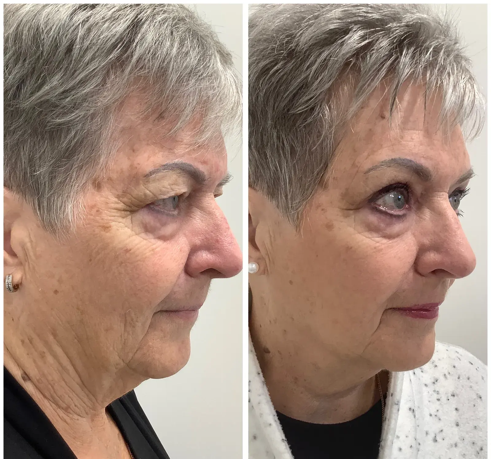 Upper eyelids, oblique view, before and after at Barrie Plastic Surgery