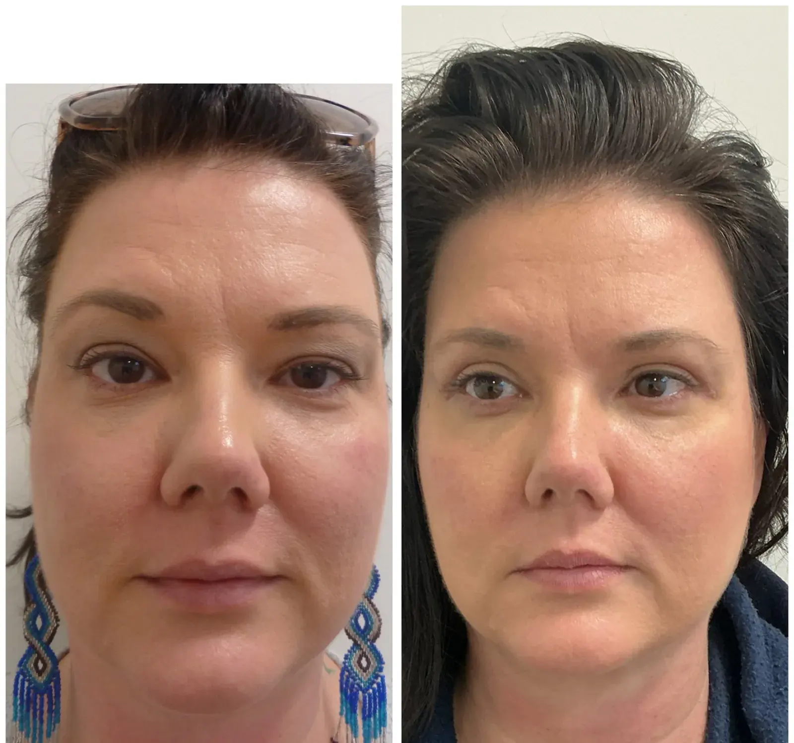 Upper eyelids, front view, before and after at Barrie Plastic Surgery