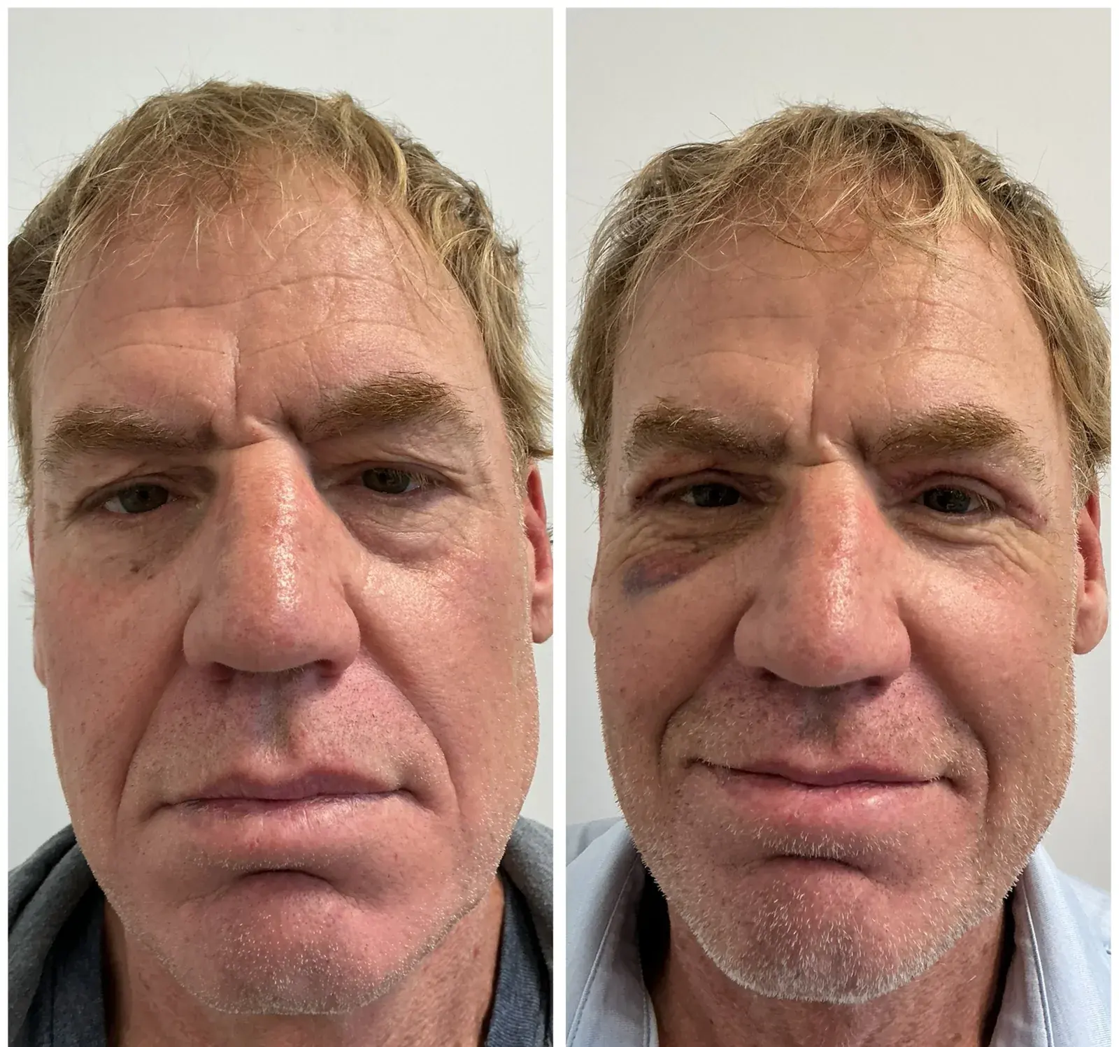 Upper eyelids, front view, before and after at Barrie Plastic Surgery