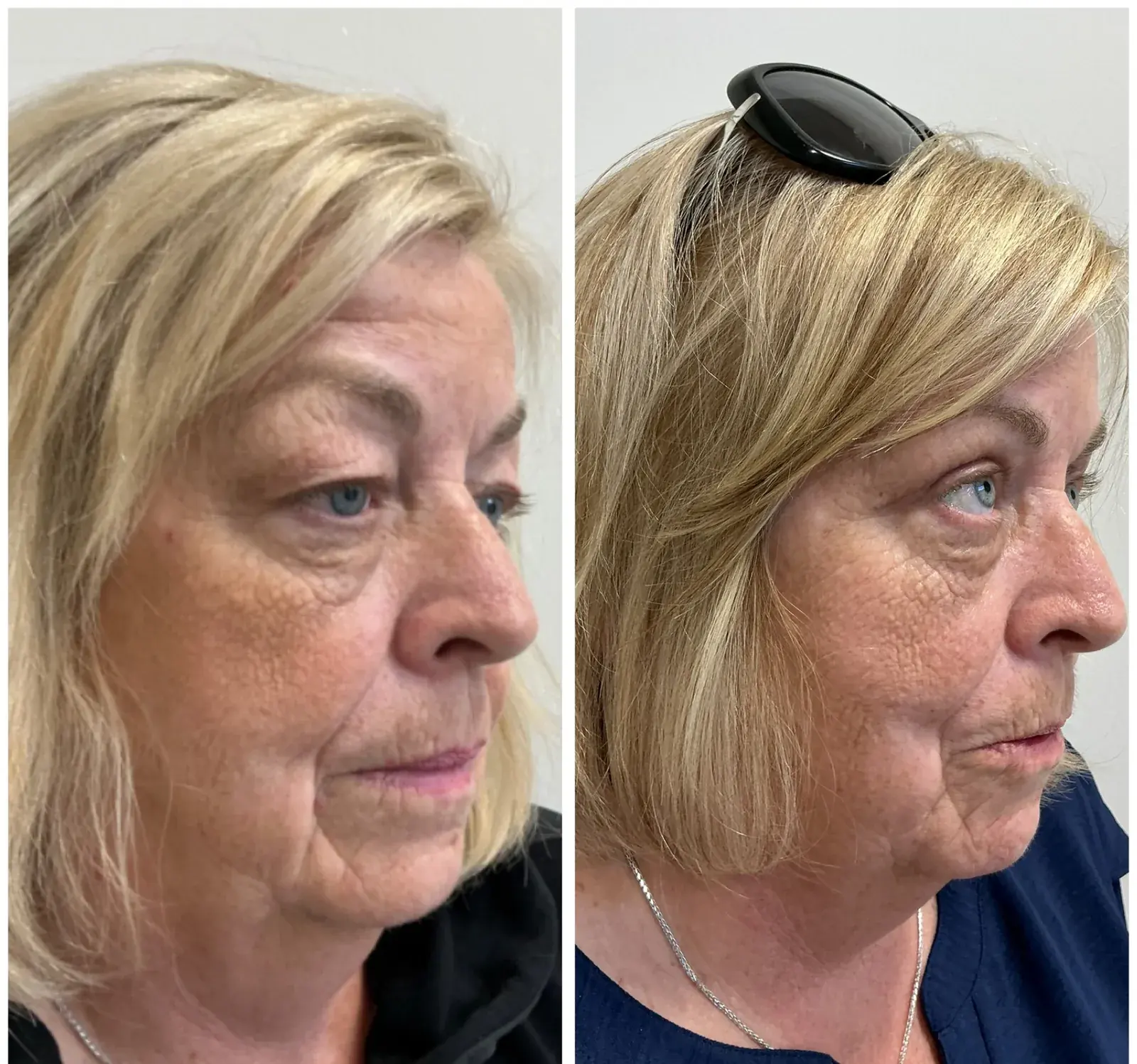 Upper eyelids, oblique view, before and after at Barrie Plastic Surgery