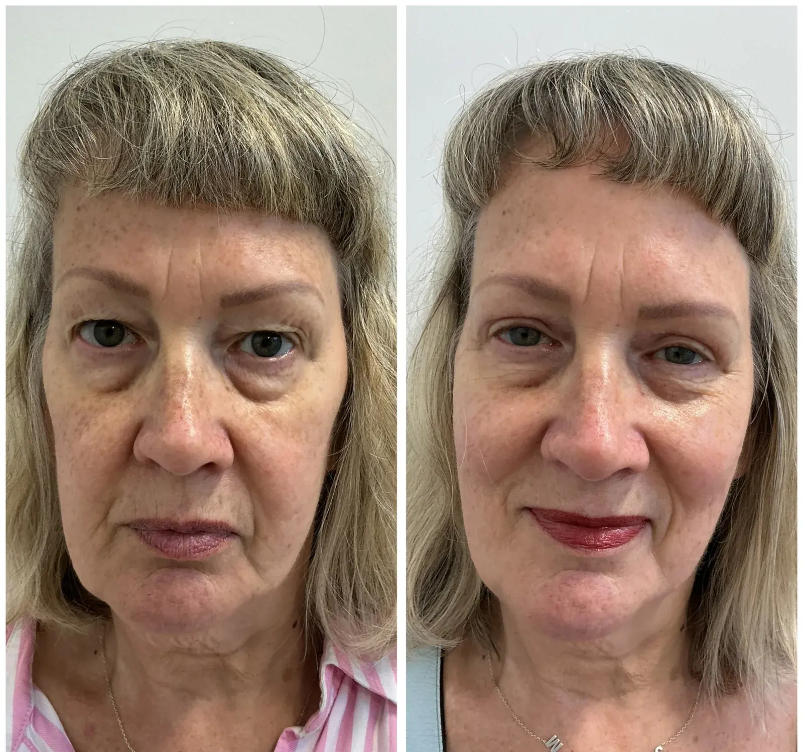 Upper eyelids, front view, before and after at Barrie Plastic Surgery