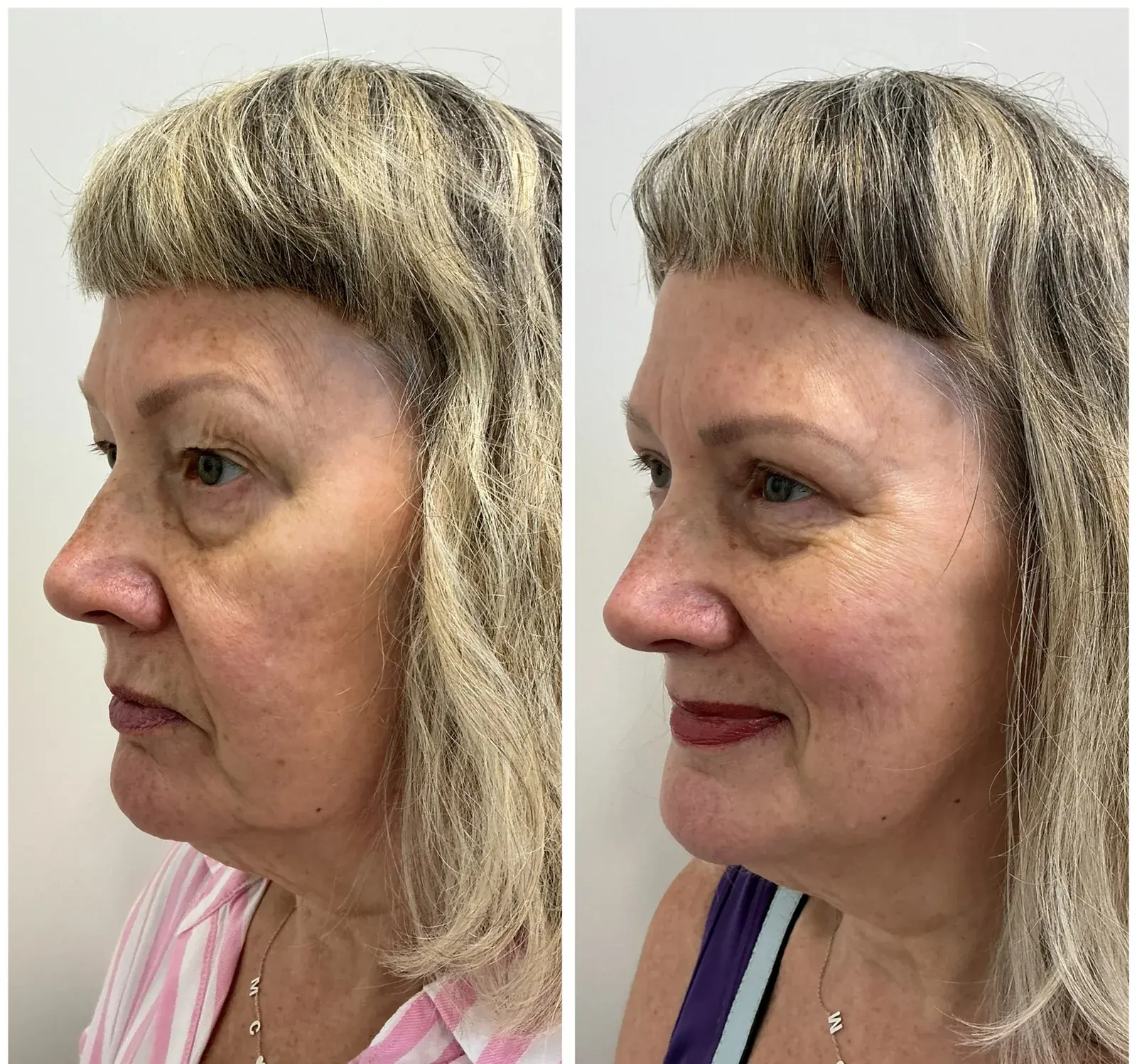 Upper eyelids, side view, before and after at Barrie Plastic Surgery