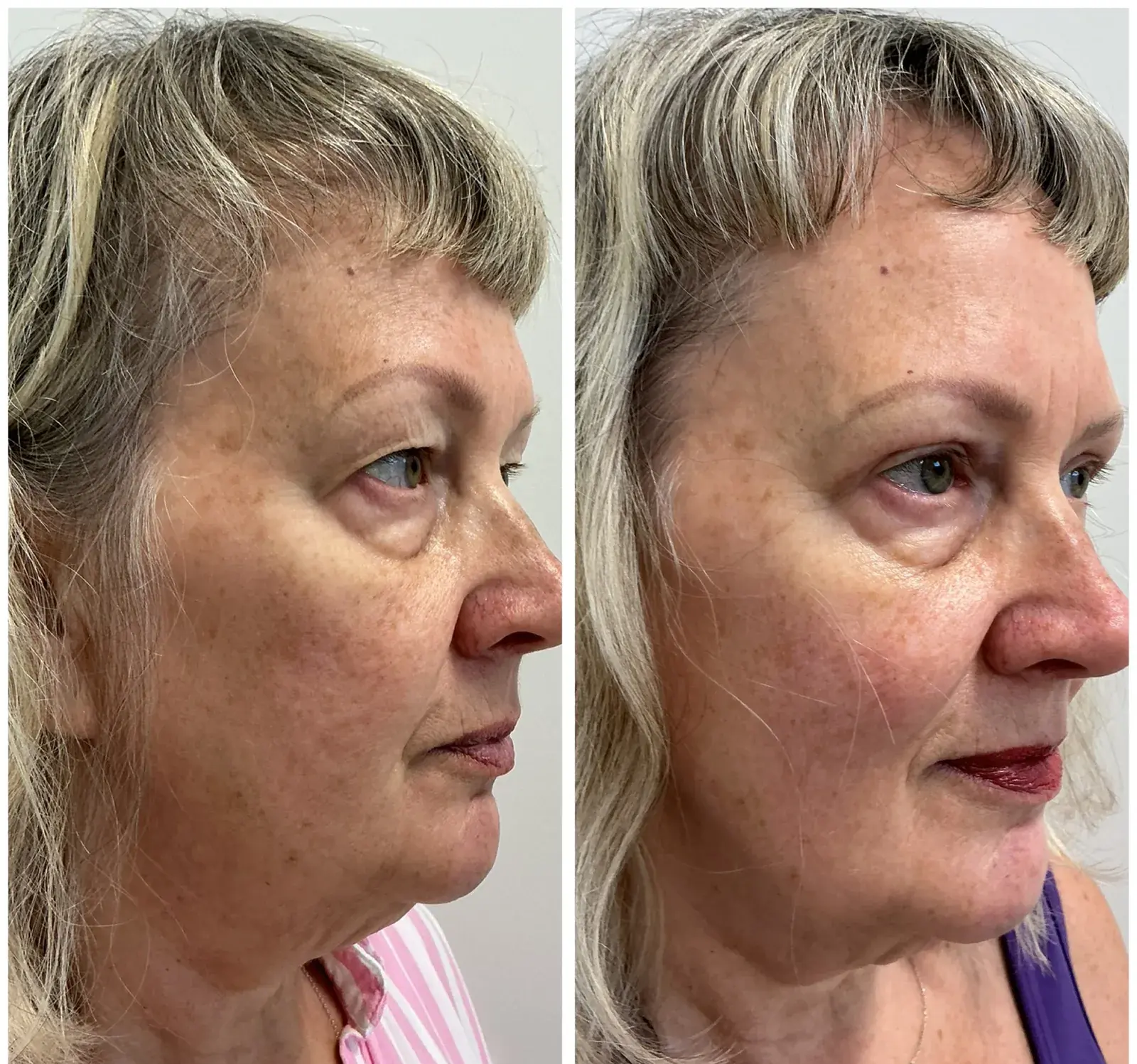 Upper eyelids, oblique view, before and after at Barrie Plastic Surgery