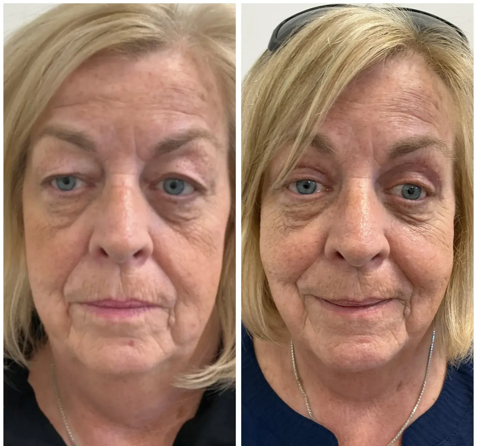 Upper eyelids, front view, before and after at Barrie Plastic Surgery