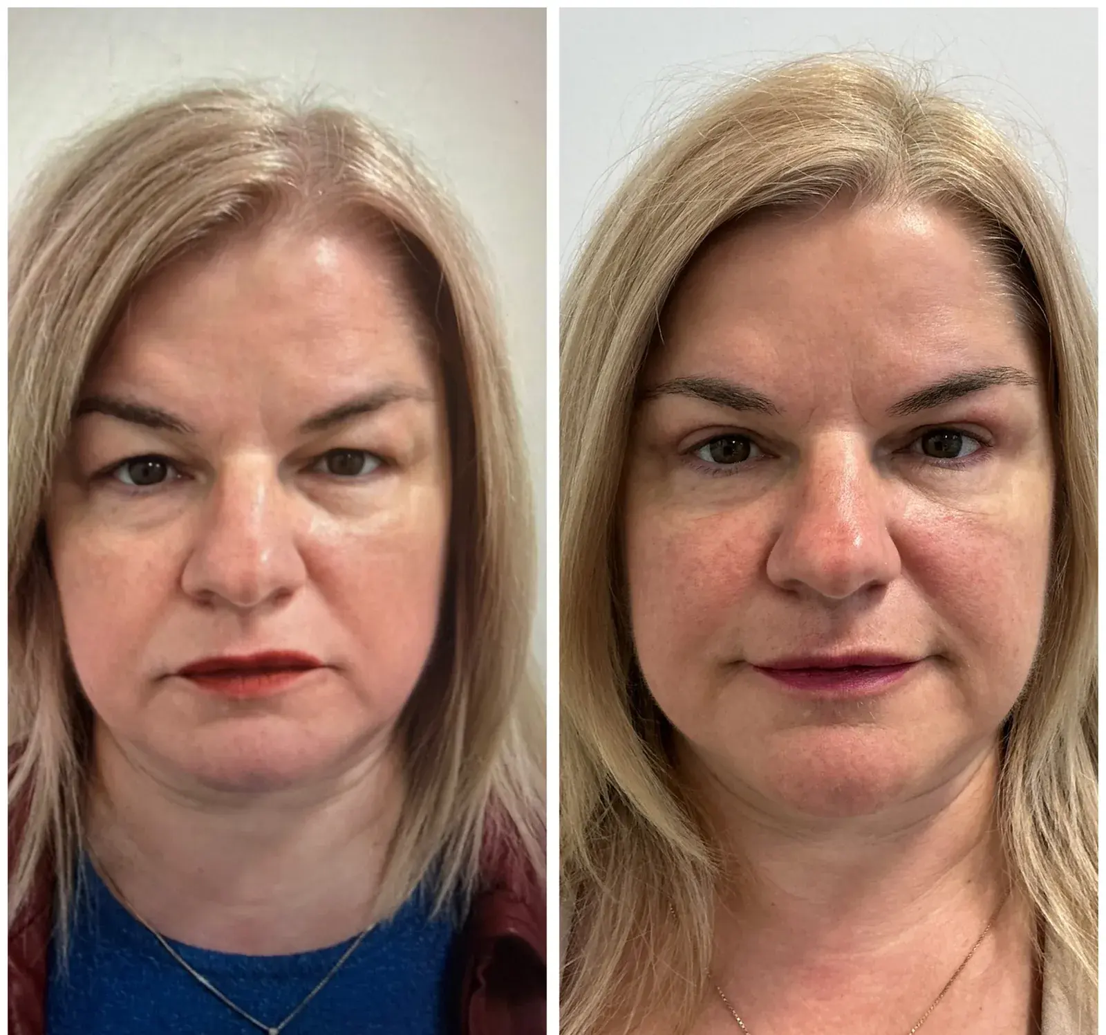 Upper eyelids, front view, before and after at Barrie Plastic Surgery